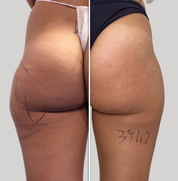 pre e post lipolaser