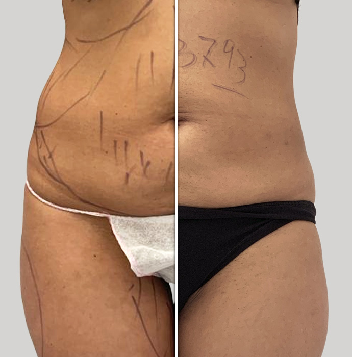 pre e post lipolaser