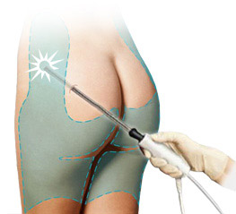 liposuzione lipolaser system liposuzione lipolaser system