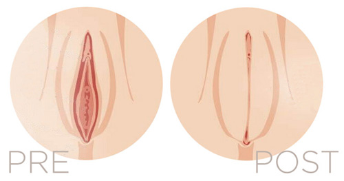 filler vagina