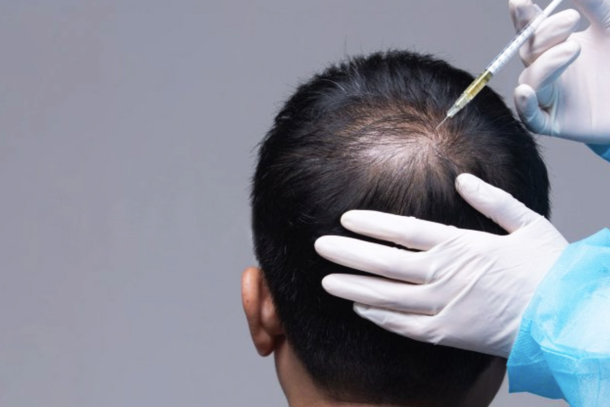 Prp Capelli